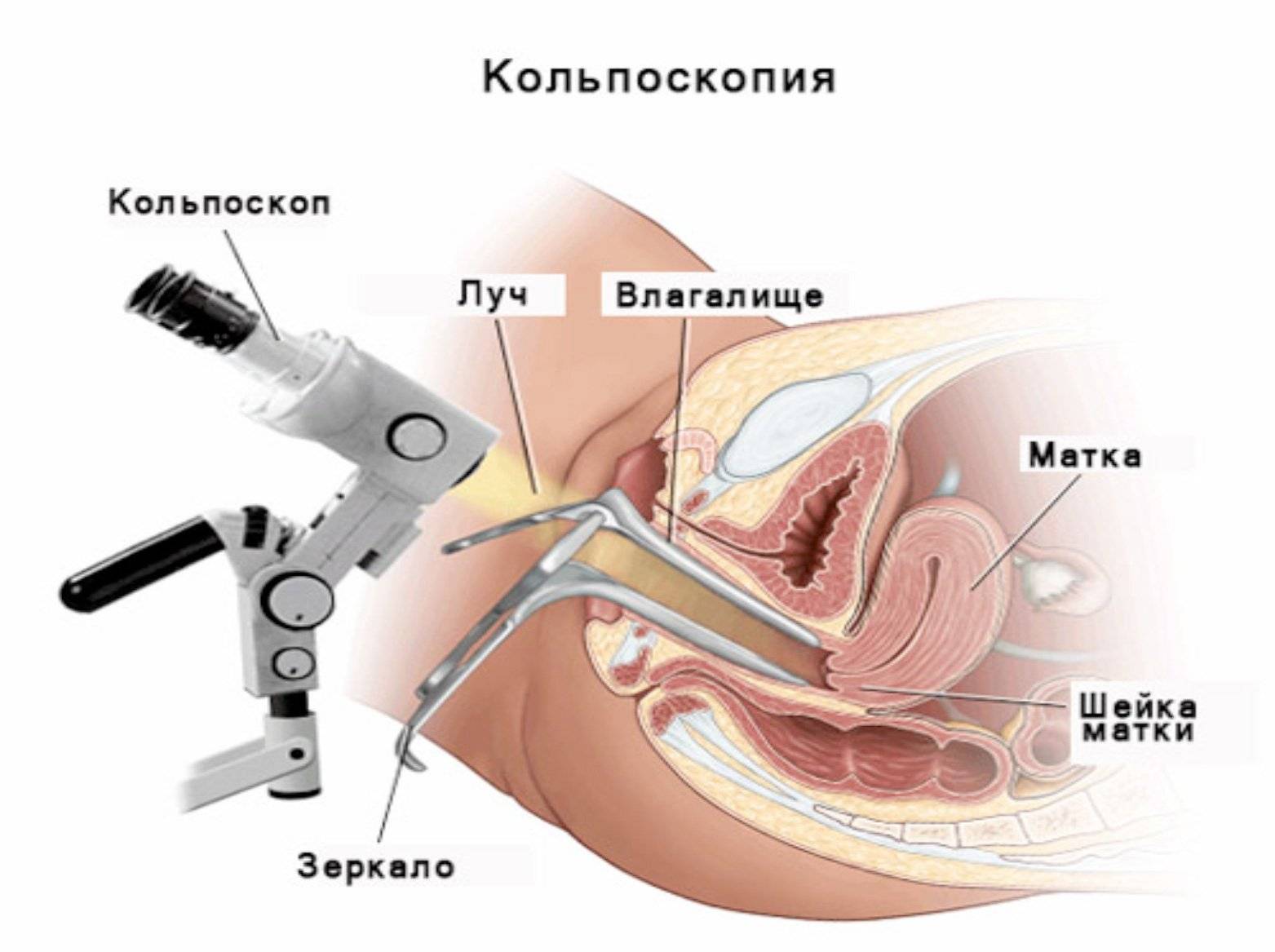 кольпоскопия процедура кольпоскопия процедура