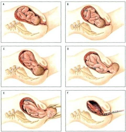 процесс родов