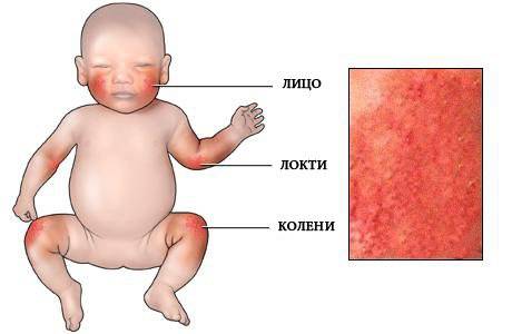 атопический дерматит у ребенка  