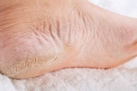 Причины появления трещин на ногах и их лечение