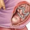 Положение и предлежание плода при беременности: тазовое, головное, поперечное,…