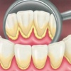 Как избежать появления зубного налета и камней?