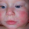Атопический дерматит у ребенка: причины, симптомы, лечение
