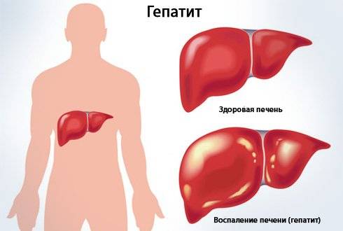 гепатит