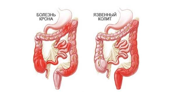 колит